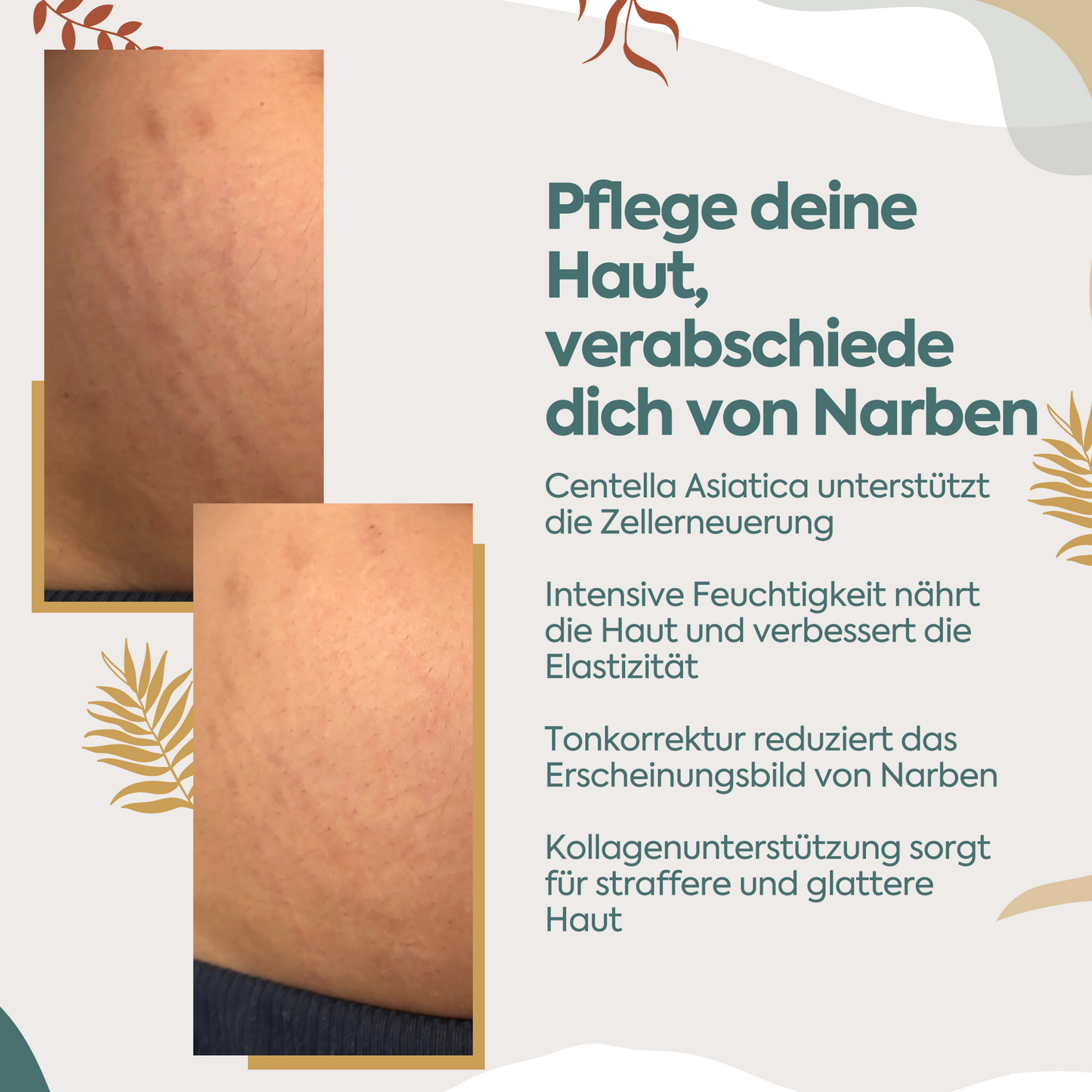 Perfekte Regeneration gegen Narben & Dehnungsstreifen – 100 ml