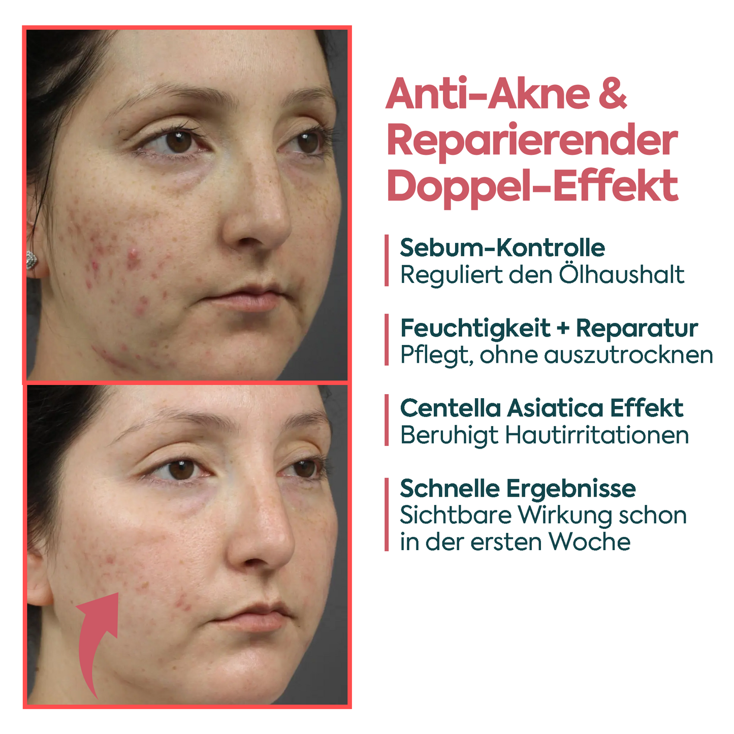 Perfekte Wirkung gegen Akne & Pickel – FACEUPSKIN® für unreine Haut 40 ml
