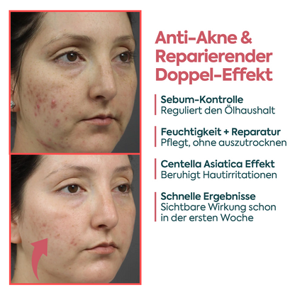 Perfekte Wirkung gegen Akne & Pickel – FACEUPSKIN® für unreine Haut 40 ml