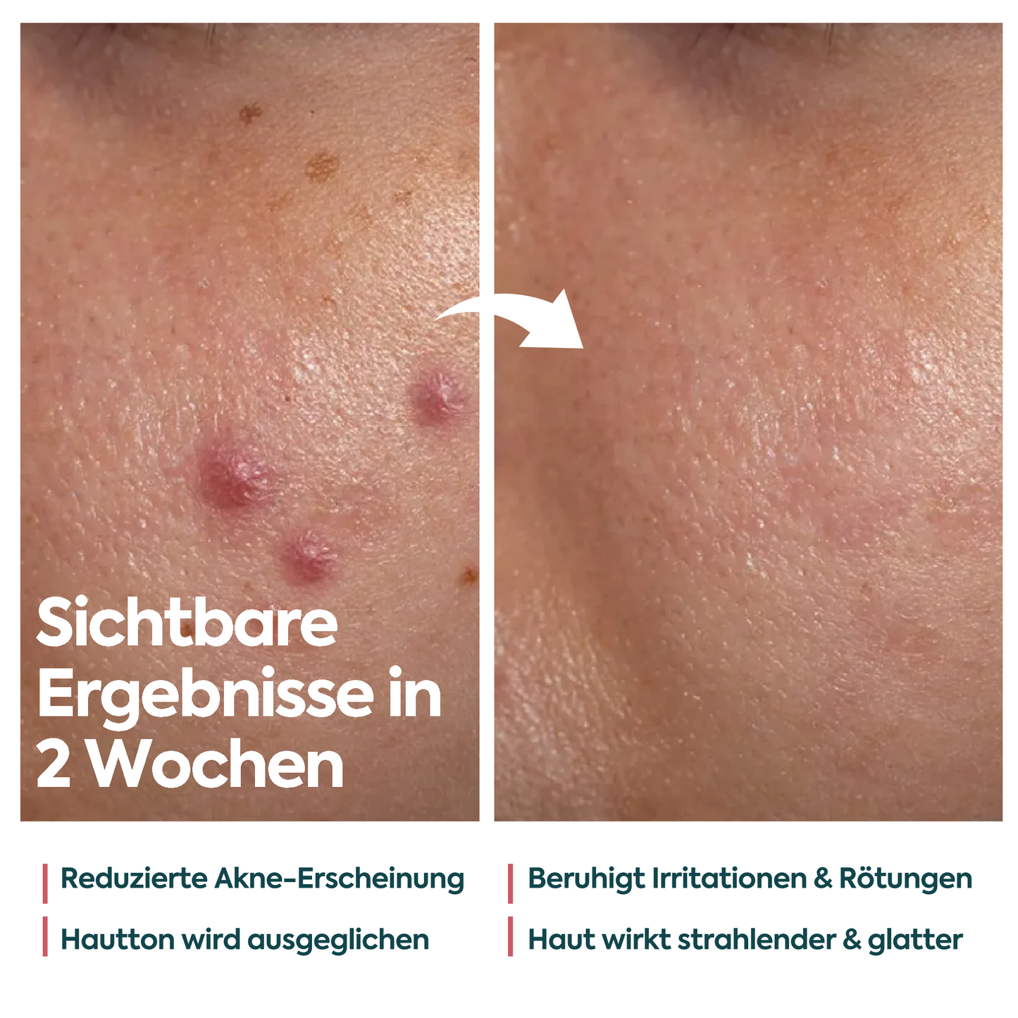 Perfekte Wirkung gegen Akne & Pickel – FACEUPSKIN® für unreine Haut 40 ml