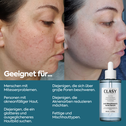 Anti-Mitesser & Akne Serum – 50 ml